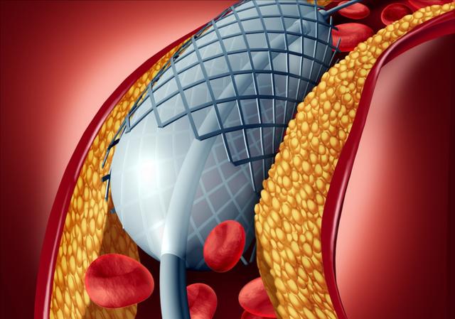 2025年最新发布：心脏支架进口型号价格大盘点